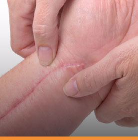 traumakingperu-carrousel-fisioterapia-en-cicatrices